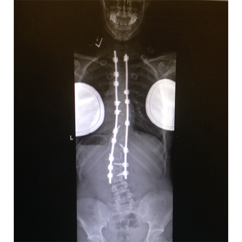 X-Ray of a spine with metal screws and rods